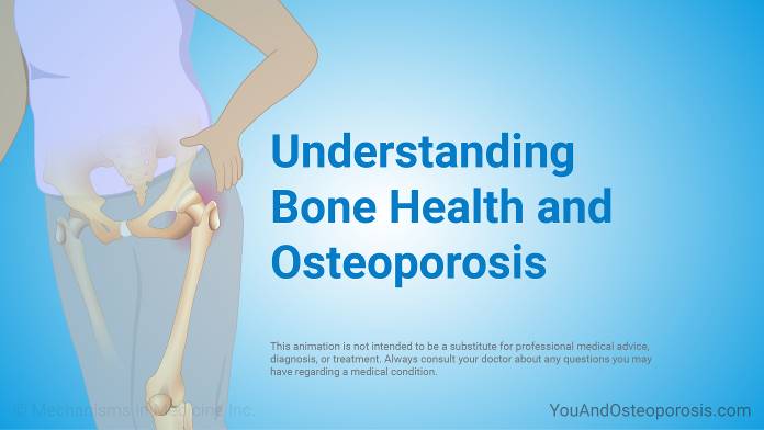 Slide Show - Understanding Osteoporosis