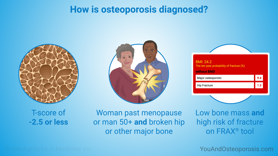 How is osteoporosis diagnosed?