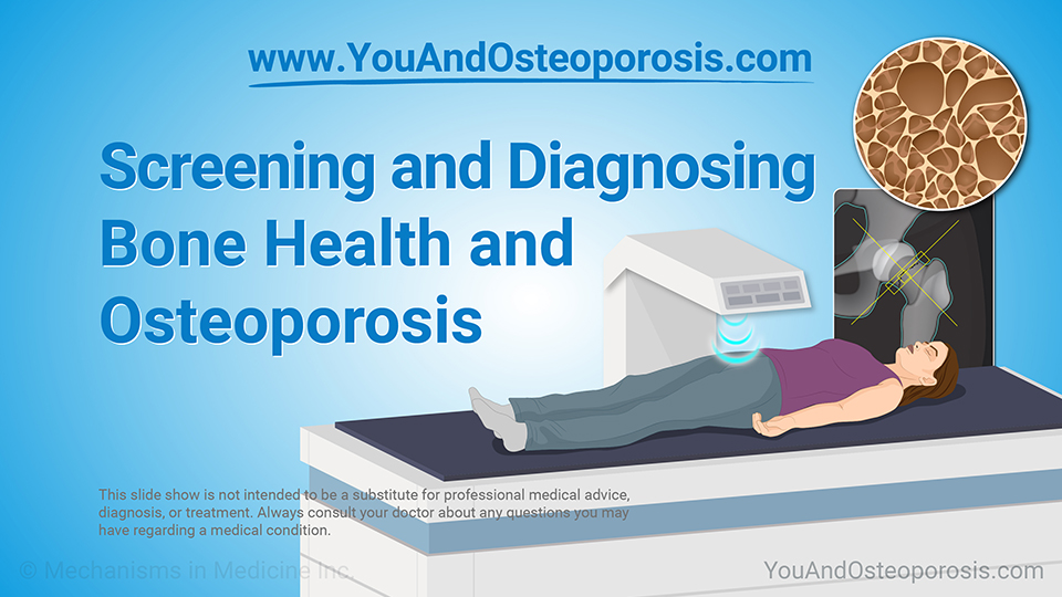 Get screened for osteoporosis using DEXA scans