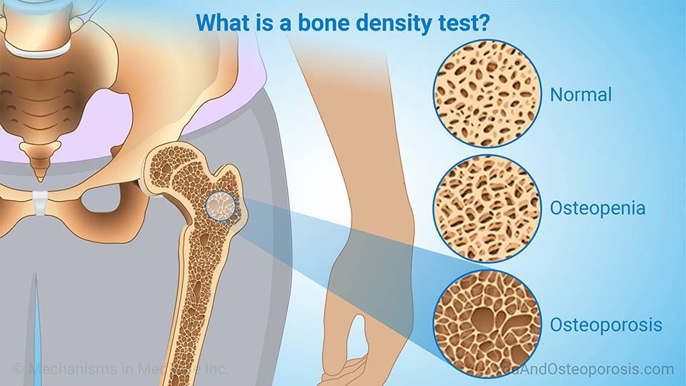 What is a bone density test?