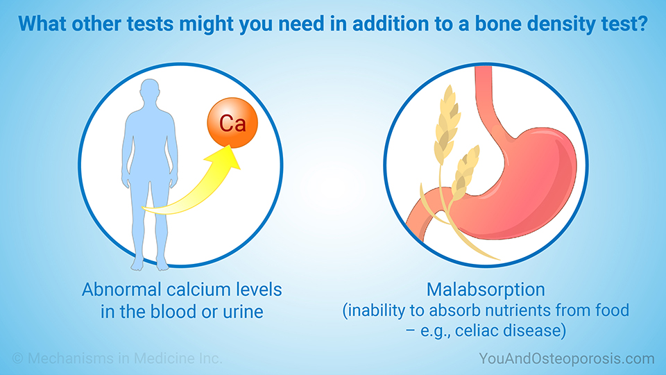 What other tests might you need in addition to a bone density test?