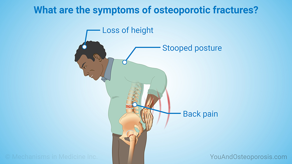 What are the symptoms of osteoporosis fractures?