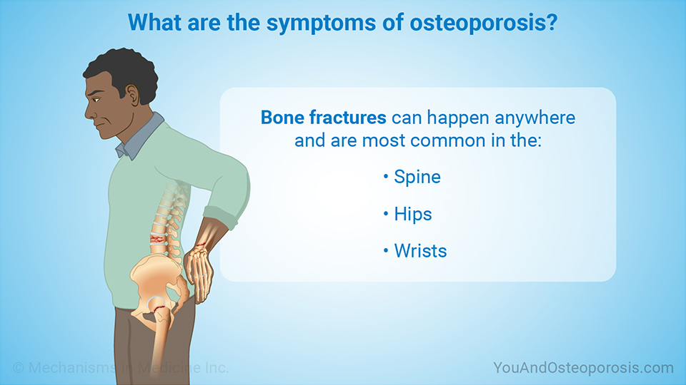 What are the symptoms of osteoporosis?