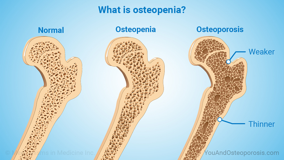 What is osteopenia?