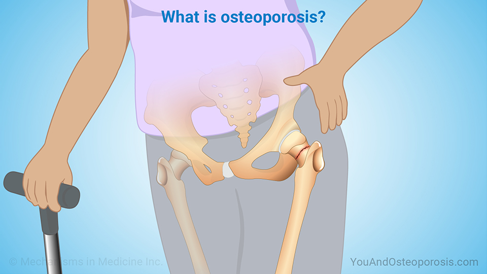 What is osteoporosis?