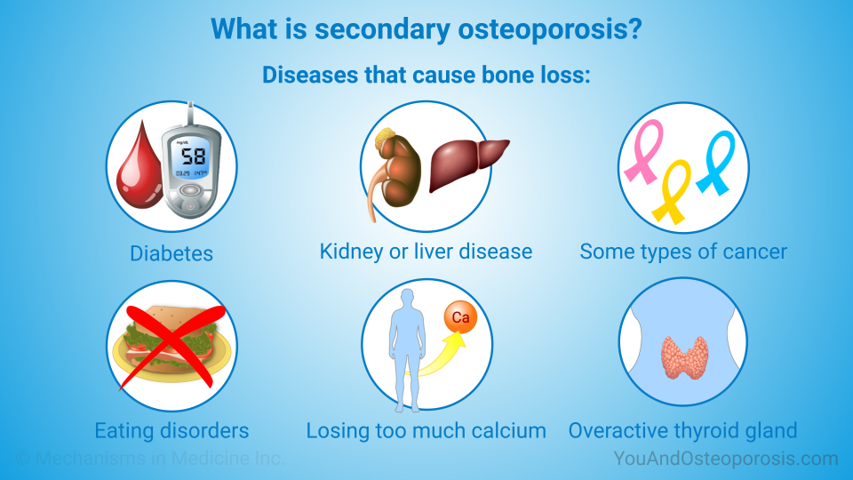 What is secondary osteoporosis?
