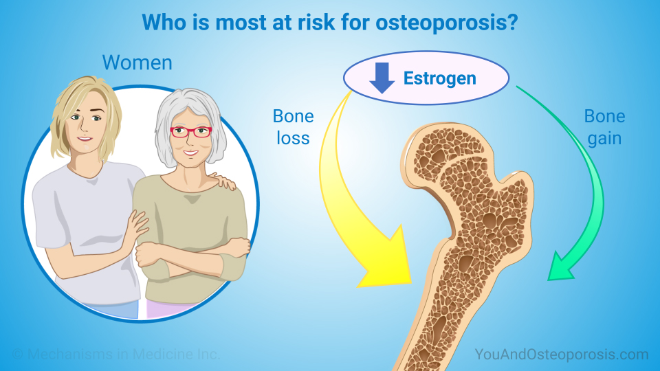 Who is most at risk for osteoporosis?